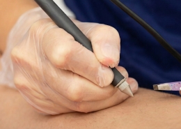 Elettrodepilazione con ago a Pavia